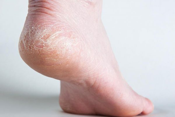 5 loại kem chữa da chân bị khô nứt nẻ tốt nhất