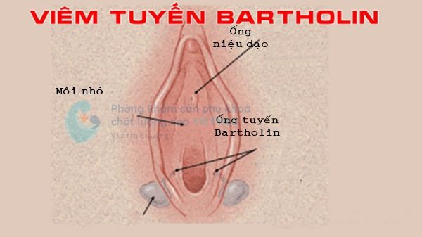 Bệnh viêm tuyến bartholin là gì?