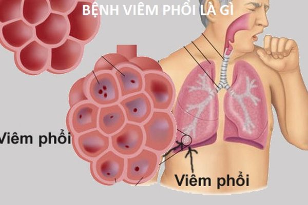 Bệnh viêm phổi ( Pneumonia ) là gì